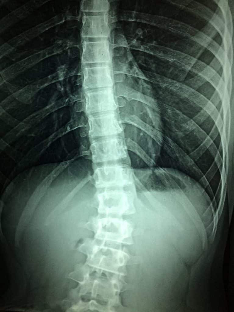 X-ray of spinal cord injury